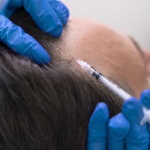 Microneedling